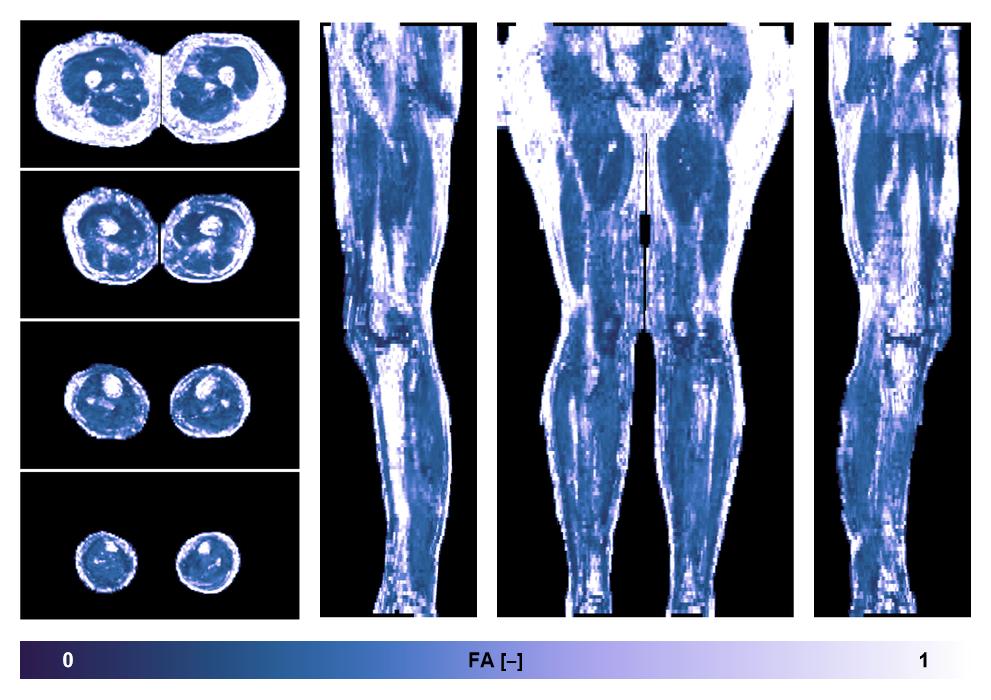 IVIM corrected whole leg muscle fractional anisotropy obtained from diffusion tensor imaging.